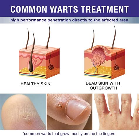 Fast-acting Liquid Corn & Wart Remover Patch - Plantar, Common, Flat ...