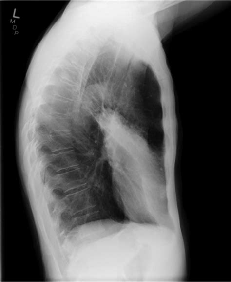 Luftsichel Sign And Juxtaphrenic Peak Sign Bmj Case Reports