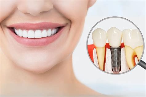 Bone Graft For Dental Implant Dental Park