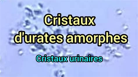 Cristaux D Urates Amorphes Cristaux Urinaires Youtube