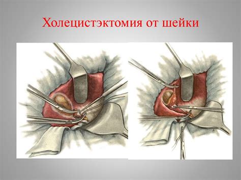 Острый холецистит - презентация онлайн