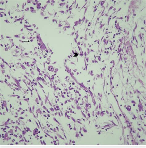 Hematoxylin And Eosin Stain Of The Uterine Inflammatory Myofibroblastic