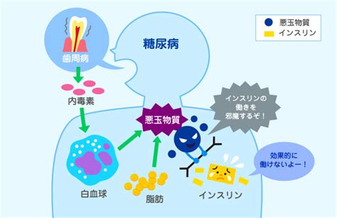 歯周病の治療が糖尿病を改善に役立つ！ | 【公式】関口デンタルオフィス埼玉 | さいたま市北区宮原の歯医者・歯科で審美インプラント治療