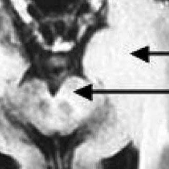 Gliomatosis cerebri diffusion pattern | Download Scientific Diagram