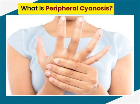 Central Cyanosis Vs Peripheral Cyanosis