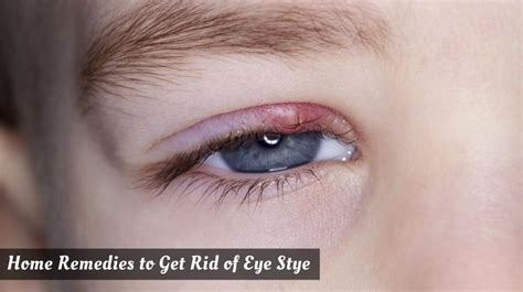 10 Quick Relief Natural Remedies for Eye Stye