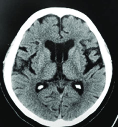 Head Ct At Admission Slightly Enlarged Ventricles With Cavum Vergae