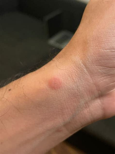 Ask A Dermatologist Online For Skin Red Bumps