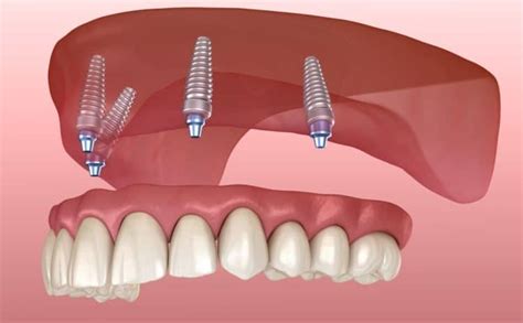 Permanent Dentures Vs Snap In Dentures Archives Advanced Dental