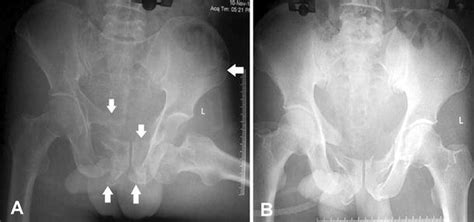 a Radiology showing anterior-inferior dislocation of left hip along ...