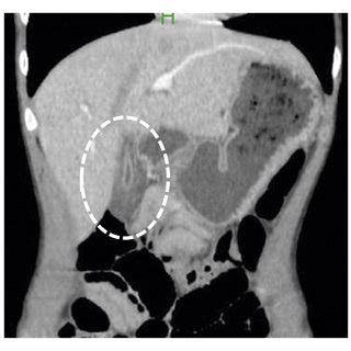 Abdominal Contrast Enhanced Computed Tomography Revealed A Circular