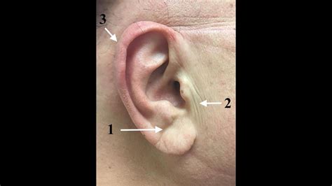 Anatomical Explanation Of Diagonal Earlobe Creases Preauricular