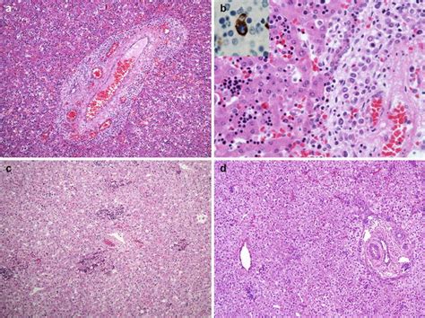normal  abnormal liver development abdominal key
