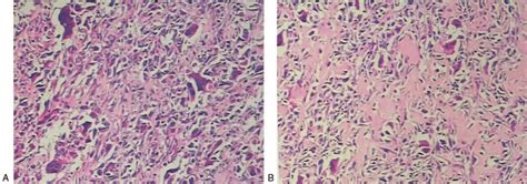 A and B Hematoxylin eosin staining 100Â shows focal necrosis