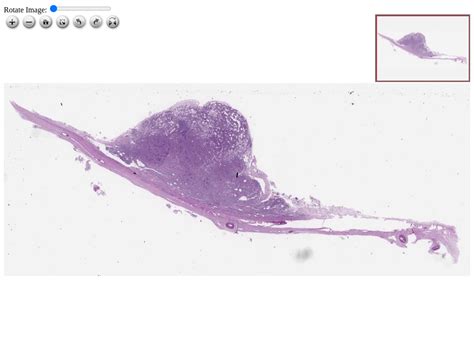 57 Meningioma Histopathology Atlas