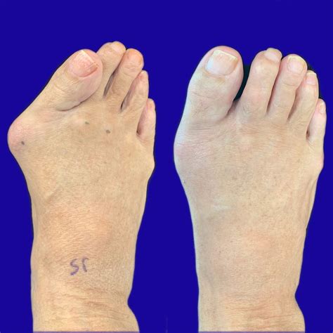 Corn And Bunion Removal Surgery at Timothy Greenwell blog
