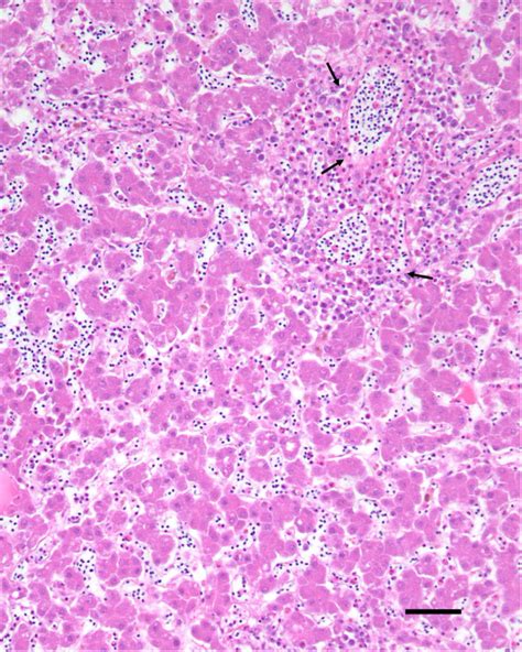 Periportal Hepatic Inflammation Histologic Section Of The Liver