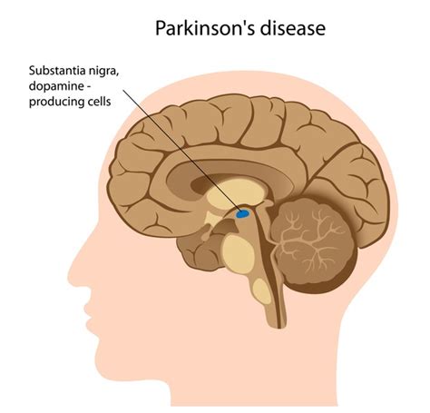 Parkinson disease: MedlinePlus Genetics