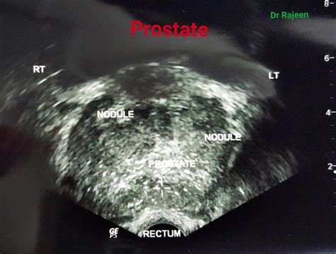 Transrectal Ultrasonography Of The Prostate Urology Malaysia