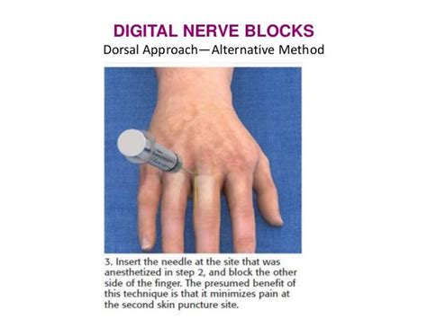 Dorsal Digital Nerve Block