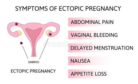 Uterus Ectopic Pregnancy