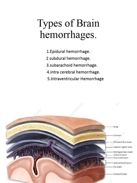 Brain Hemorrhages Types | PDF