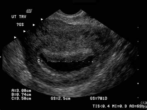 Pelvic Ultrasound Pelvic Ultrasound At 6 Weeks Pregnant