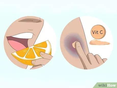 How To Make Bruises Go Away Quickly Effective Easy Ways Artofit