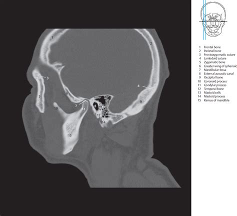 Sagittal Ct