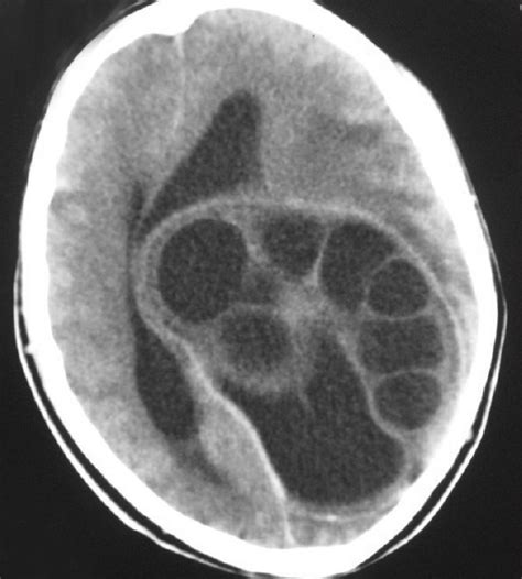 Ncct Head Showing A Multicystic Lesion With Multiple Daughter Cysts In