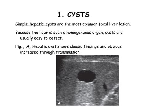 Liver Ultrasound | PPT