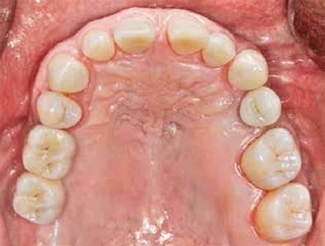 Maxillary Arch Anatomy