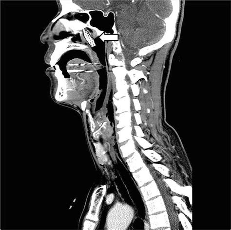 Sagittal Ct Neck Anatomy