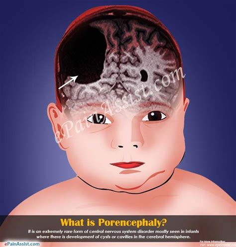 What is Porencephaly | Pathology, Central nervous system, Cysts