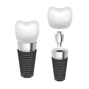 The Different Types Of Dental Implants Jackson Oral Surgery