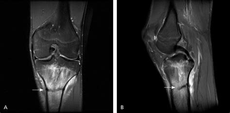 Stress Fracture Foot Shin Causes Symptoms Prevention Treatment