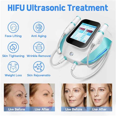 A High Intensity Focused Ultrasound With Radio Frequency Anti Aging