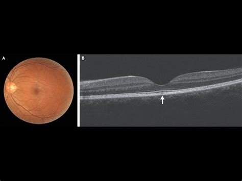 Kurzer Klinischer Fallbericht Solare Retinopathie Youtube