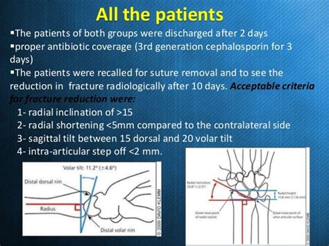 External Fixation Versus Volar Locking Plate For Displaced Intra Arti