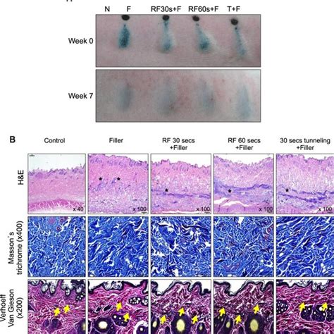 Radiofrequency RF Induced Collagen Contraction And Production In