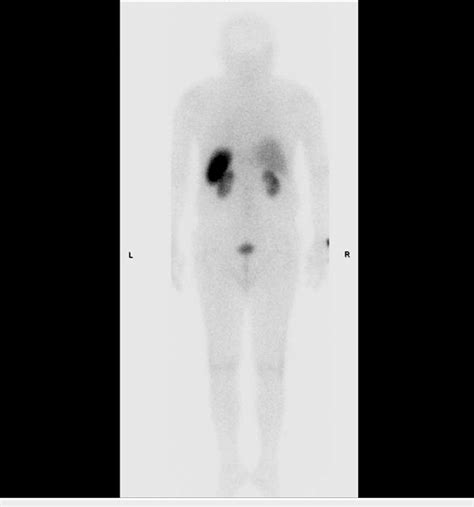 Octreotide Scan Demonstrating The Absence Of Somatostatinpositive