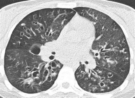 Pulmonary Disease In Cystic Fibrosis Assessment With Chest Ct At Chest