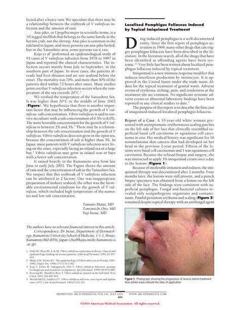 Localized Pemphigus Foliaceus Induced By Topical Imiquimod Treatment