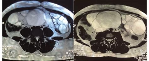 T2 Weighted Mri Image Axial Plane Through Pelvis Showing Bilateral Download Scientific Diagram