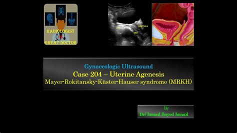 Ultrasound Case 204 Uterine Agenesis Youtube