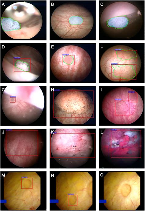 Augmented Bladder Tumor Detection Using Deep Learning European Urology