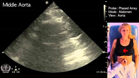 Aorta Ultrasound