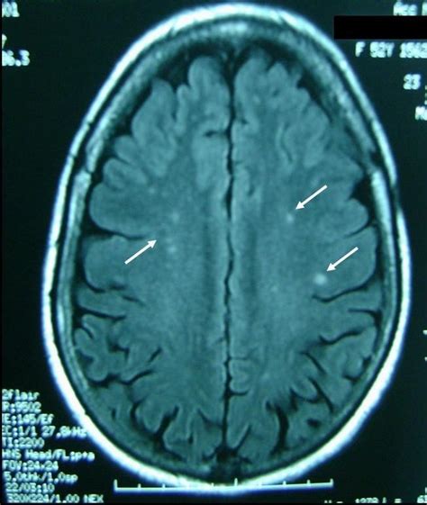 Cerebral Rheumatoid Vasculitis A Case Report Journal Of Medical Case