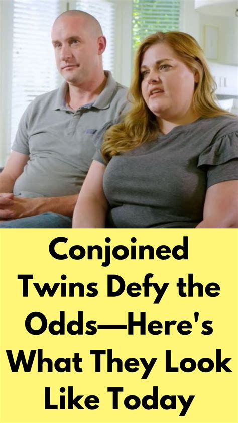 Conjoined Twins Defy The Odds—heres What They Look Like Today In 2023 Conjoined Twins Twins