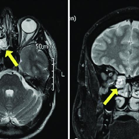 MRI Brain And Orbits Showing A Right Sided Well Defined Mass Near The